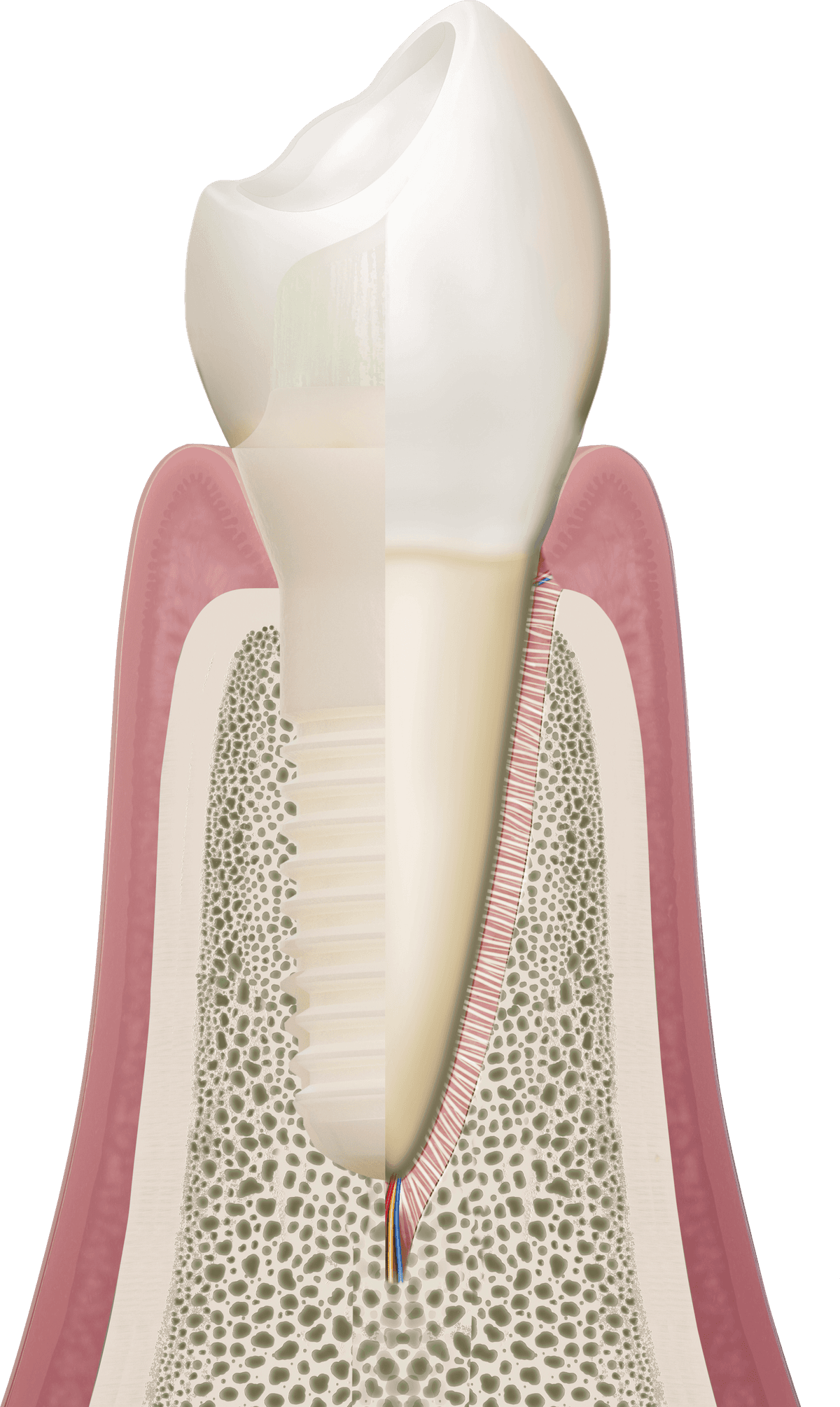 Patent™ Keramikimplantat im Kiefer