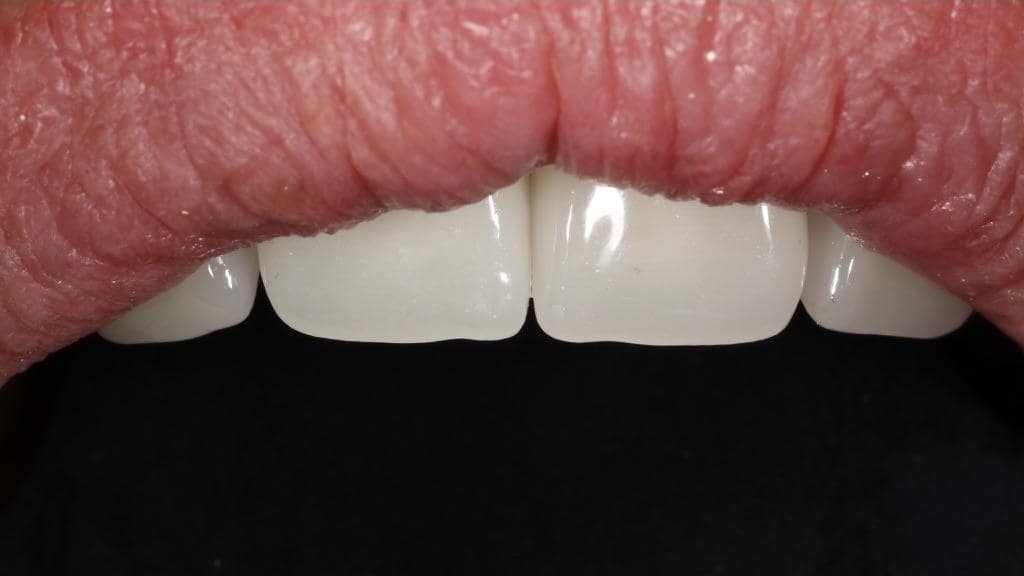 Veneers bei LifeDent