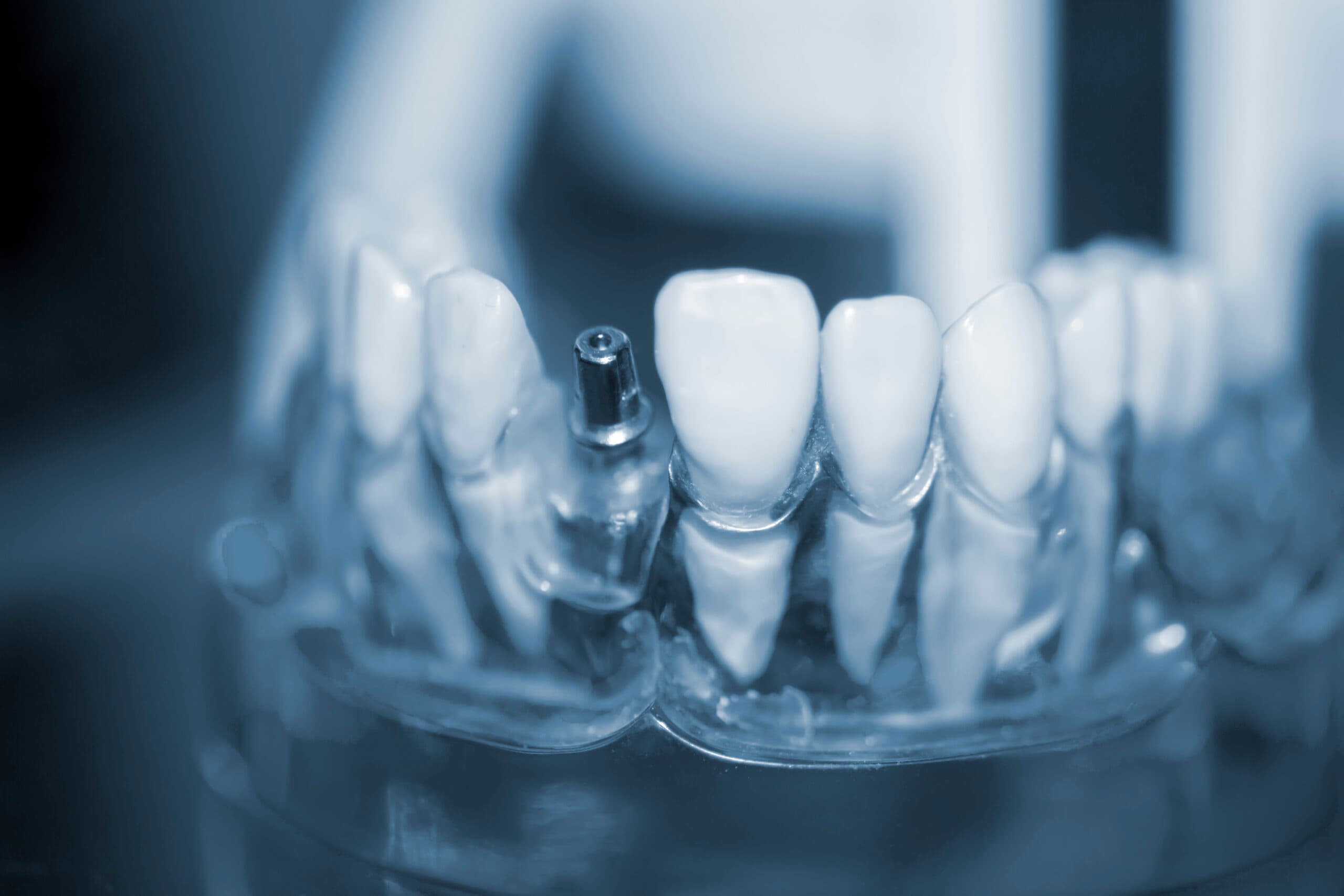 Werden Zahnimplantate vom Körper „abgestossen“? » Lifedent