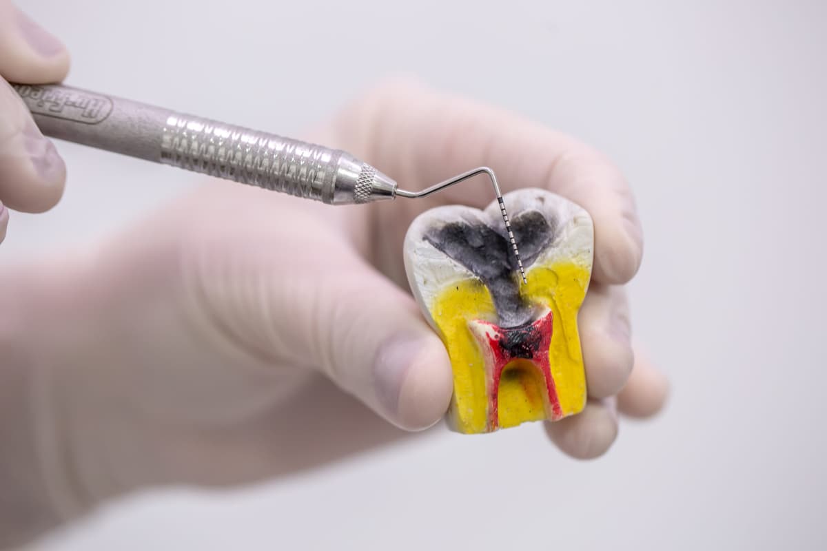 Wurzelbehandlung 2.0: Werden Laser- und Schallwellen die Endodontologie revolutionieren? » Lifedent