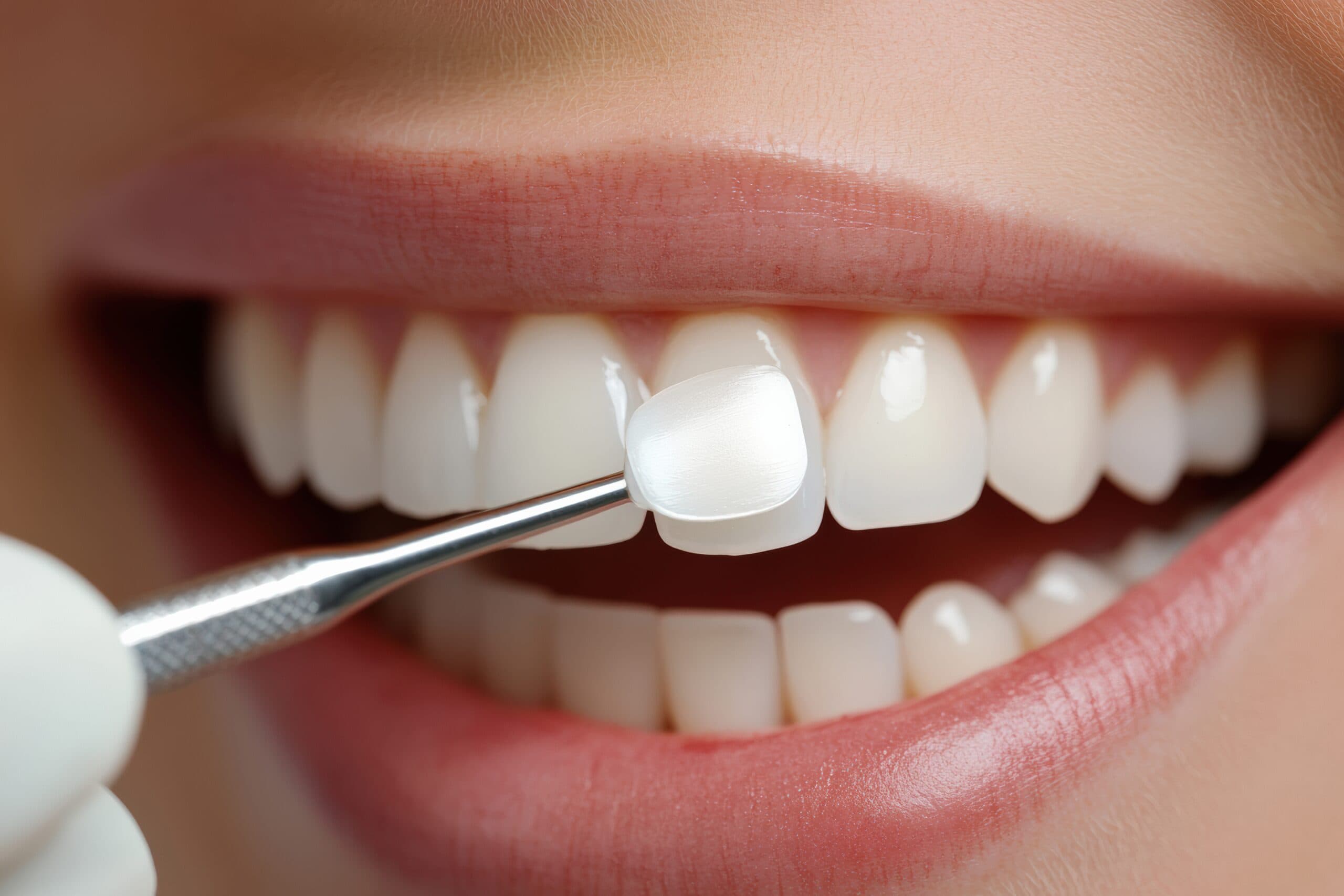 Sind Veneers gefährlich? » Lifedent